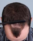 Before Hair Transplant&nbsp;Hairlines